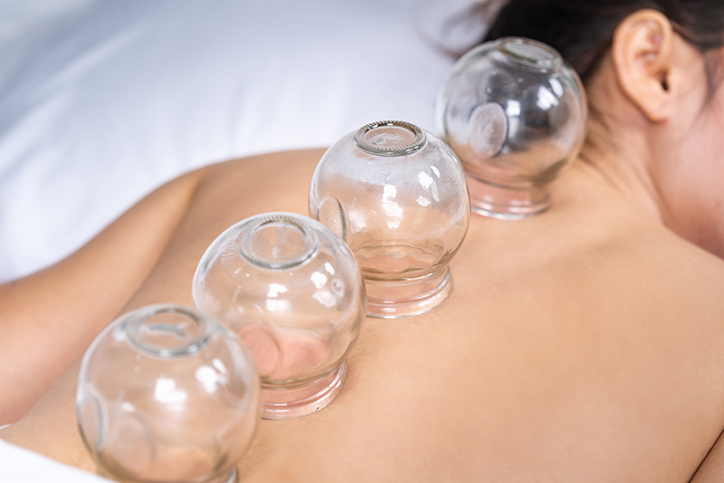 What is Cupping therapy
